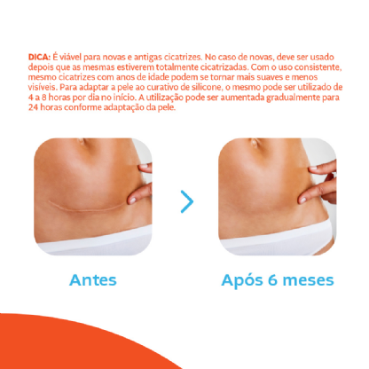 Curativo de Silicone para Cicatrização | Conforto e Eficácia na Recuperação